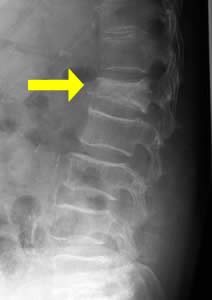 脊椎圧迫骨折(矢印部分)